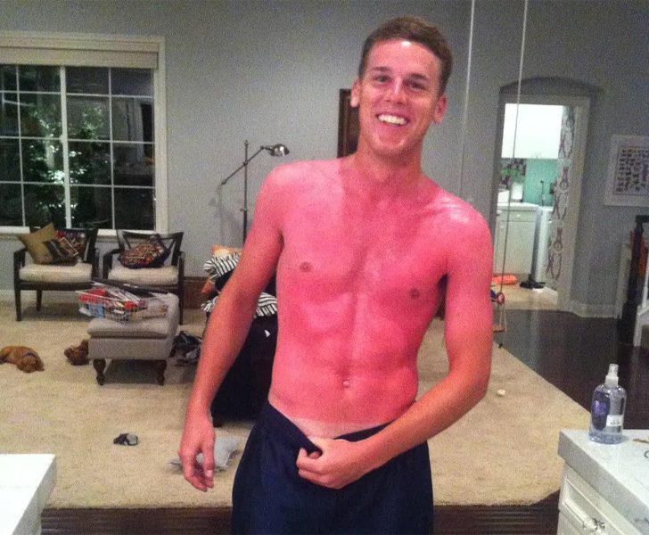 These Are The Most Ridiculous Sunburns You Will Ever See! - Investructor